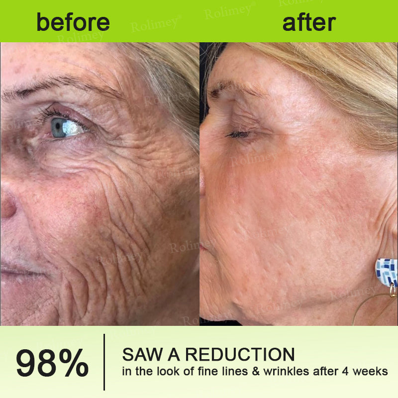 🇬🇧Made and shipped from the UK 🎁Rоlimеу® Botox & Vita-A Retinol Shot Wrinkle-Lift Tightening cream - Last Day Promotion 70% OFF