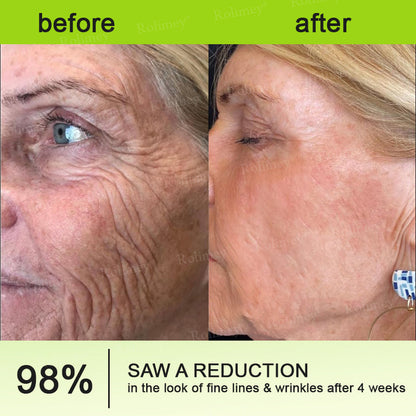 🇬🇧Made and shipped from the UK 🎁Rоlimеу® Botox & Vita-A Retinol Shot Wrinkle-Lift Tightening cream - Last Day Promotion 70% OFF