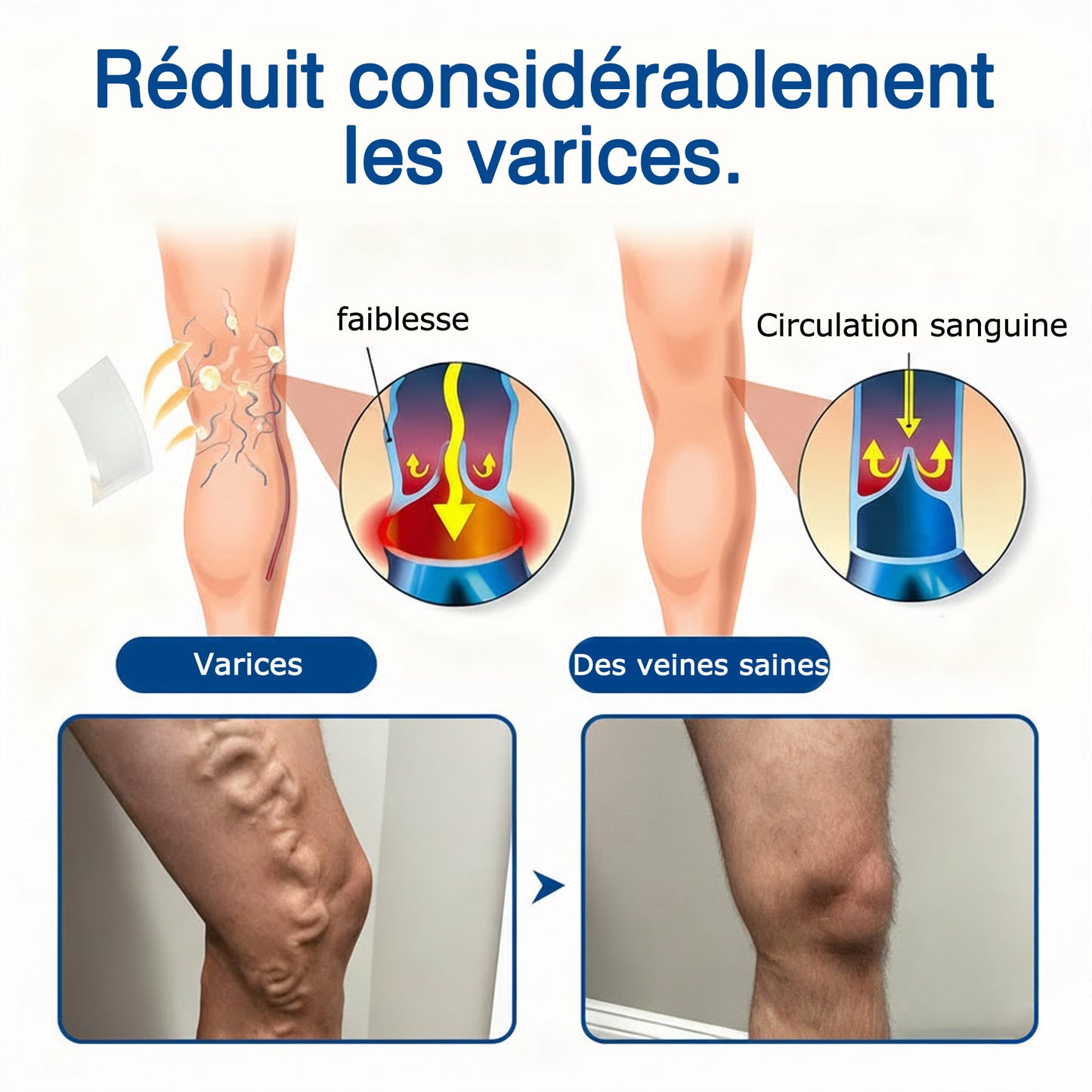 GFOUК® VeinEase : Patchs Micro-aiguilles ⌛Soulagement Immédiat, Résultats Durables👨‍⚕️🔥