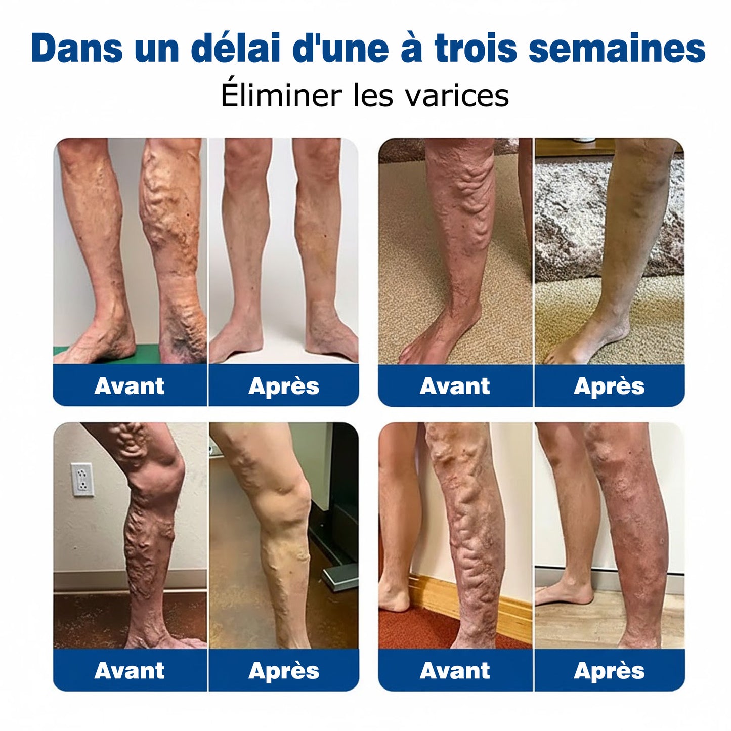 GFOUК® VeinEase : Patchs Micro-aiguilles ⌛Soulagement Immédiat, Résultats Durables👨‍⚕️🔥