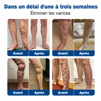 GFOUК® VeinEase : Patchs Micro-aiguilles ⌛Soulagement Immédiat, Résultats Durables👨‍⚕️🔥
