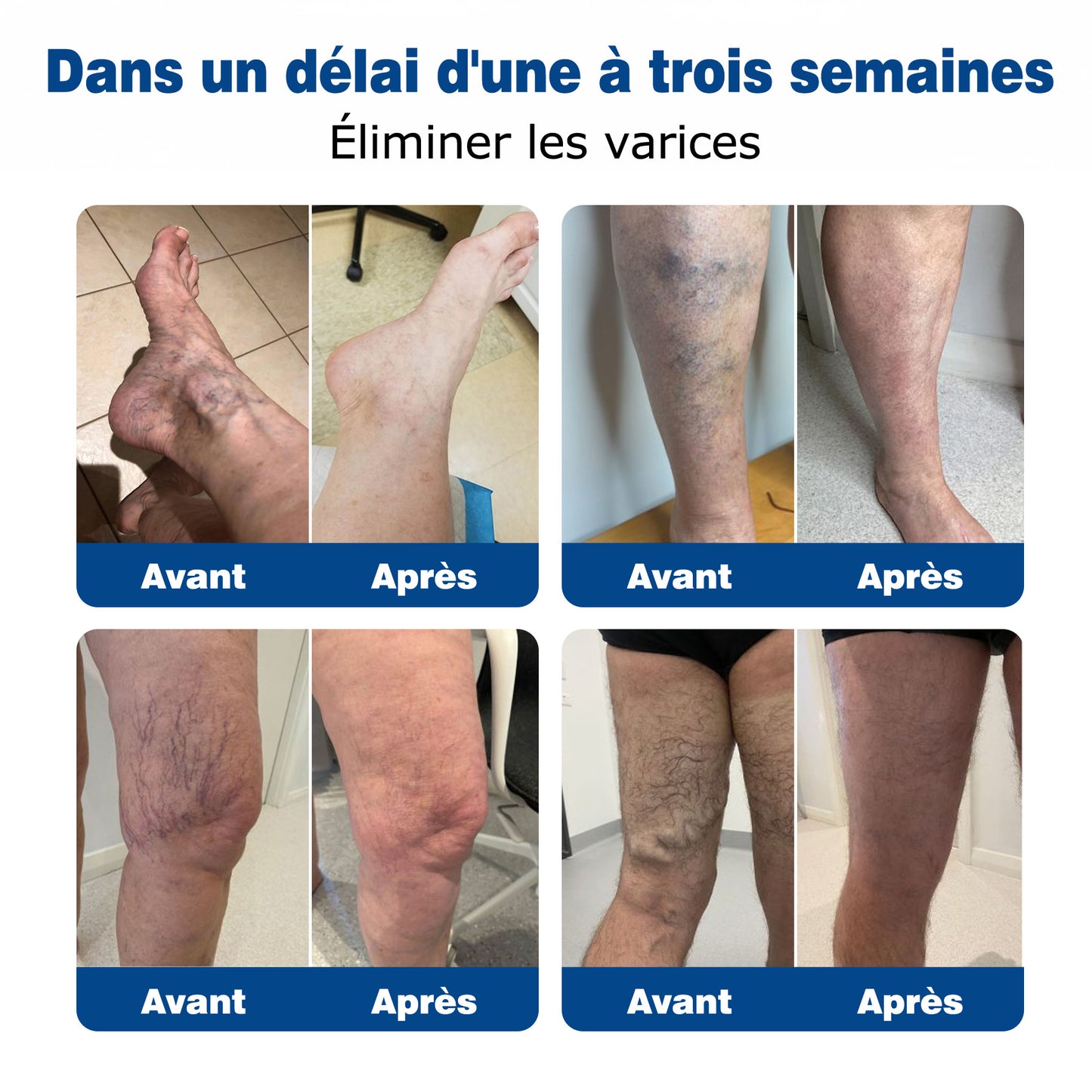 GFOUК® VeinEase : Patchs Micro-aiguilles ⌛Soulagement Immédiat, Résultats Durables👨‍⚕️🔥