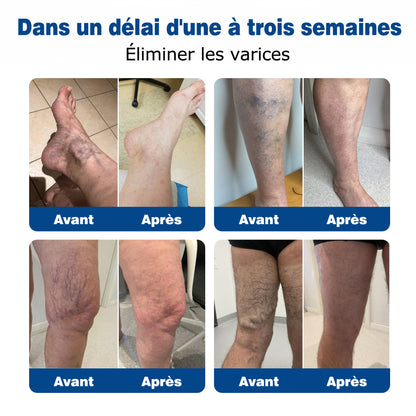 GFOUК® VeinEase : Patchs Micro-aiguilles ⌛Soulagement Immédiat, Résultats Durables👨‍⚕️🔥